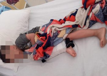 Bocah 4 Tahun di Buleleng Jadi Korban Tabrak Lari dengan Kaki Patah, Polisi Buru Pelaku