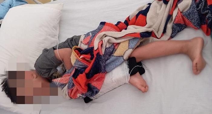 Bocah 4 Tahun di Buleleng Jadi Korban Tabrak Lari dengan Kaki Patah, Polisi Buru Pelaku